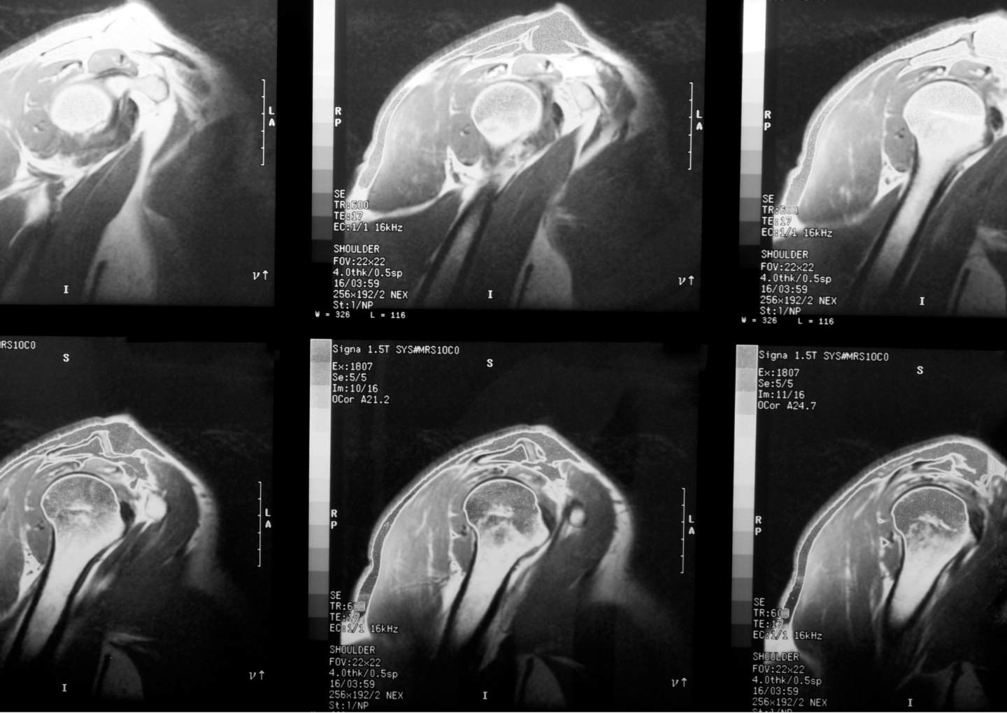 Your Rotator Cuff - PART 1: Is Your Shoulder In Trouble?