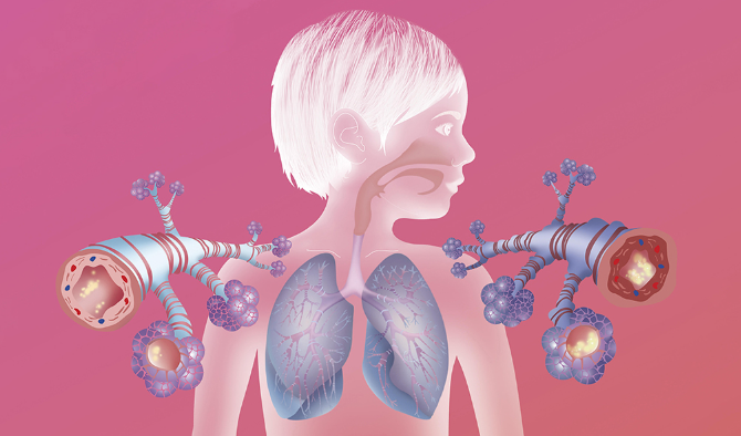 More than 260 million people worldwide suffer from asthma, yet existing treatments often fail to control the disease. New approaches may offer better treatments.  CREDIT: BSIP SA / ALAMY STOCK PHOTO