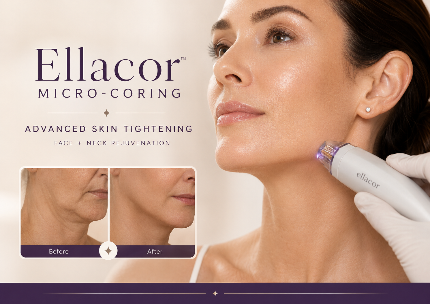 Ellacor Micro-Coring