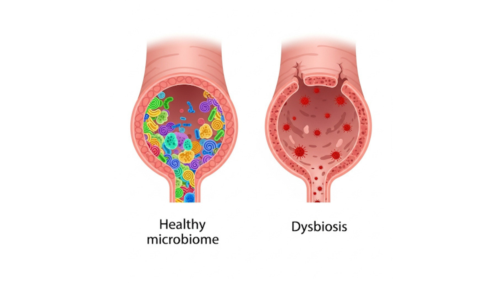 Imagen que muestra una comparación entre un intestino sano y otro con disbiosis