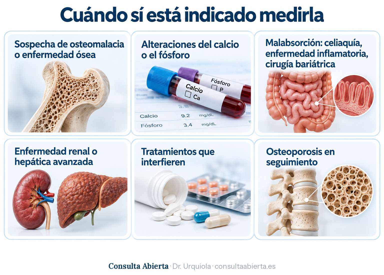 Situaciones en las que sí está indicado medir la vitamina D: sospecha de osteomalacia, alteraciones del calcio o el fósforo, malabsorción, enfermedad renal o hepática avanzada, tratamientos que interfieren y osteoporosis en seguimiento