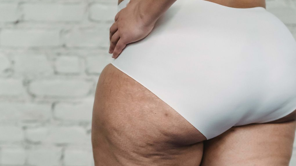 Lipedema