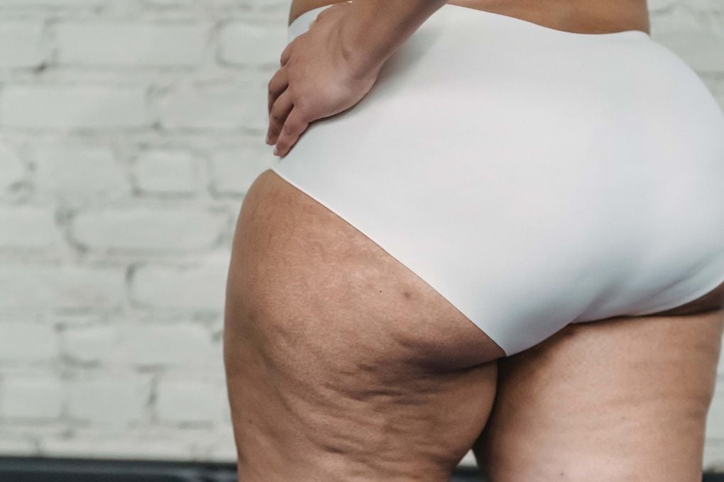 Lipedema