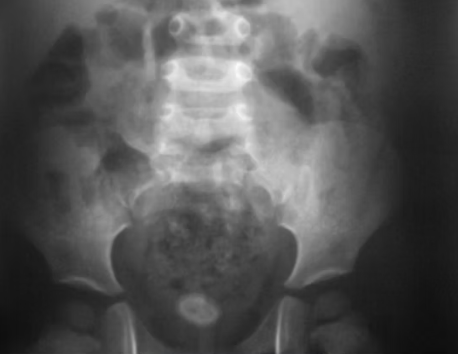 Litiásis Urinaria. ¿Qué es eso?