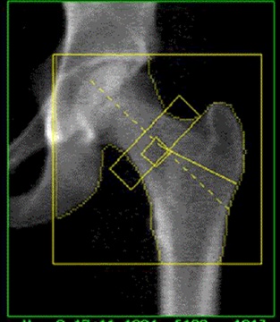 Exercise + osteoporosis medication: do they work together or against each other?