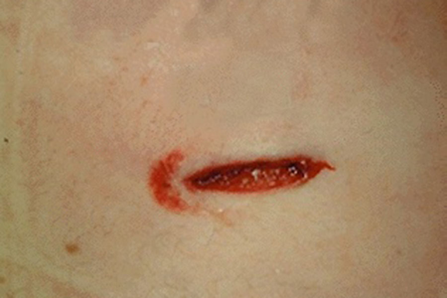 Stab Wounds