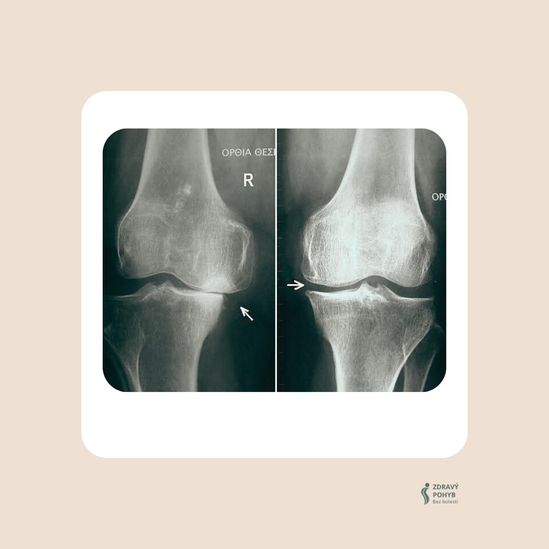 🔴 Proč bolí koleno