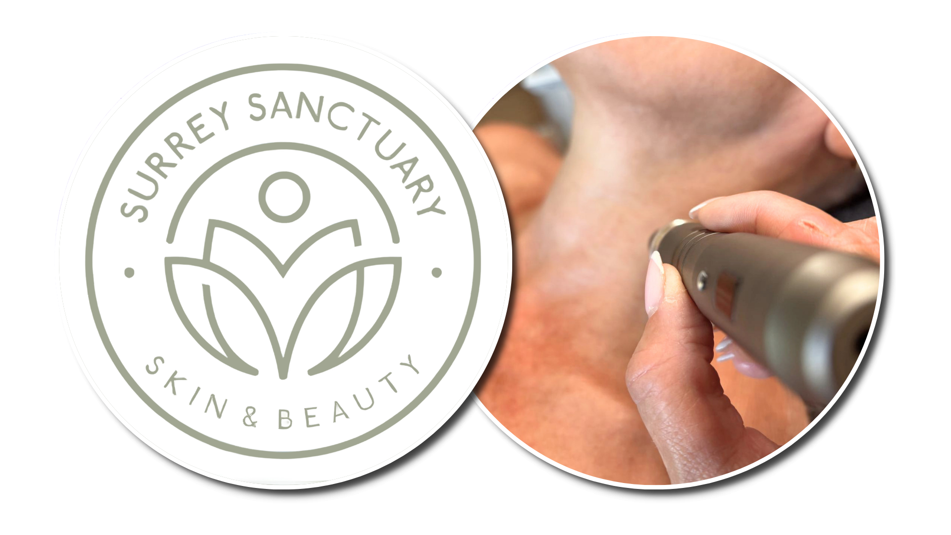 Is It Safe to Have Microneedling in Summer?