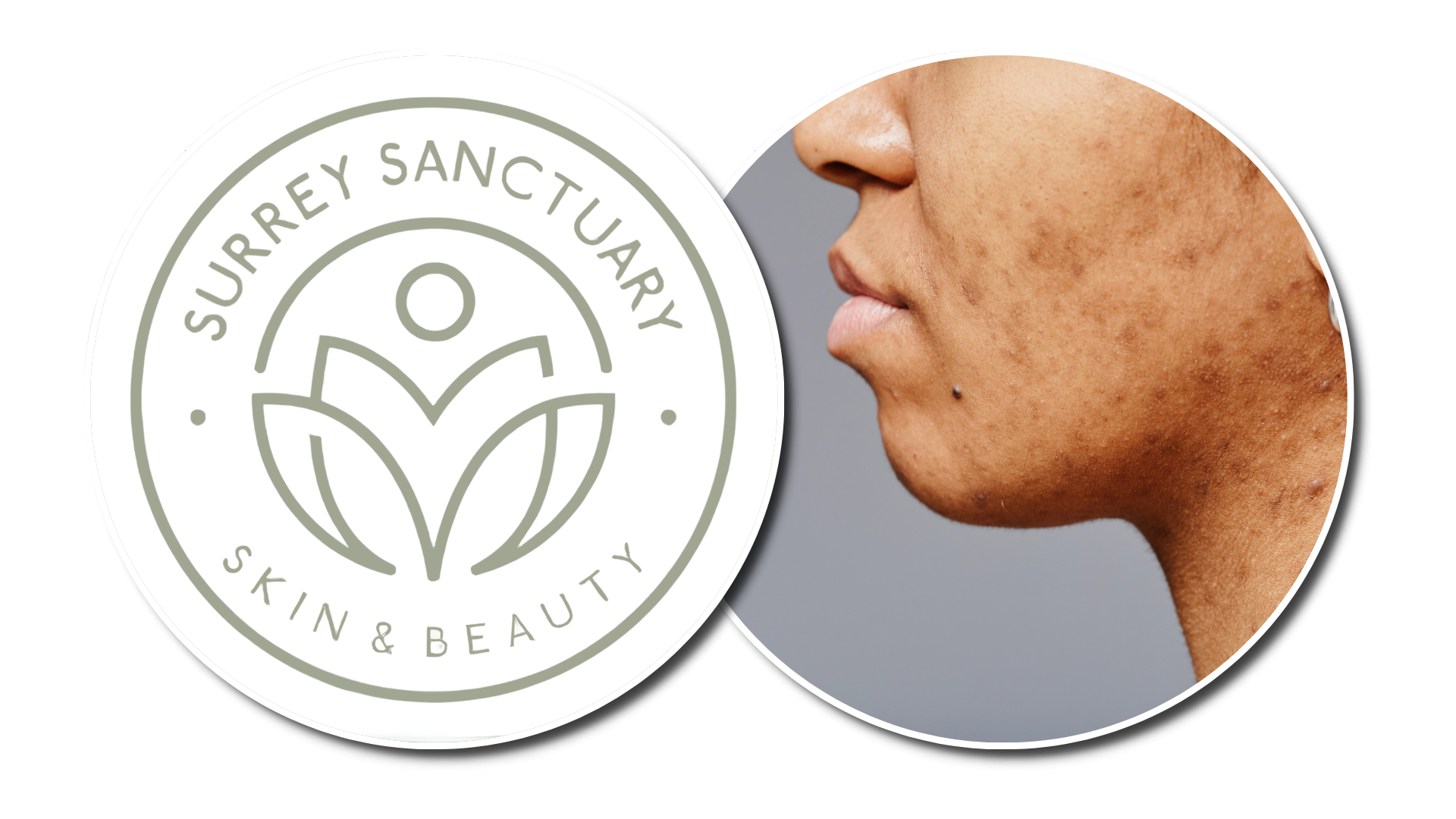 Pigmentation: Why Those Dark Patches Look More Noticeable After Summer