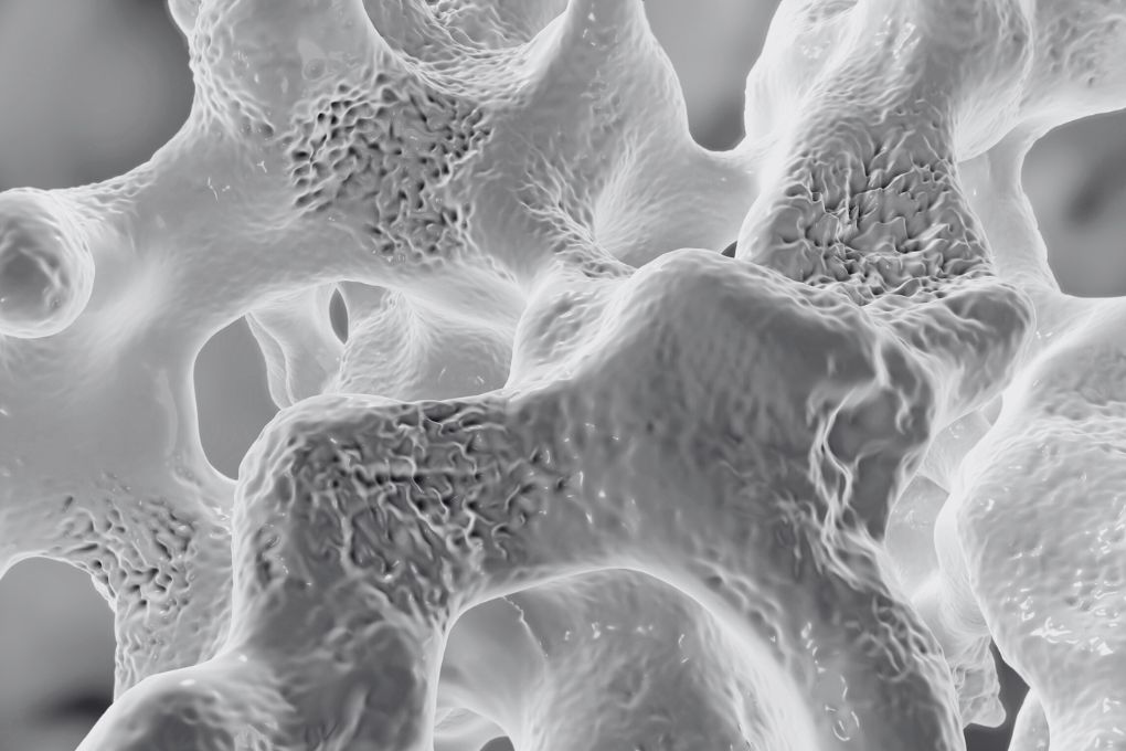 Osteoporose bei Frauen: Ursachen, Symptome und Prävention