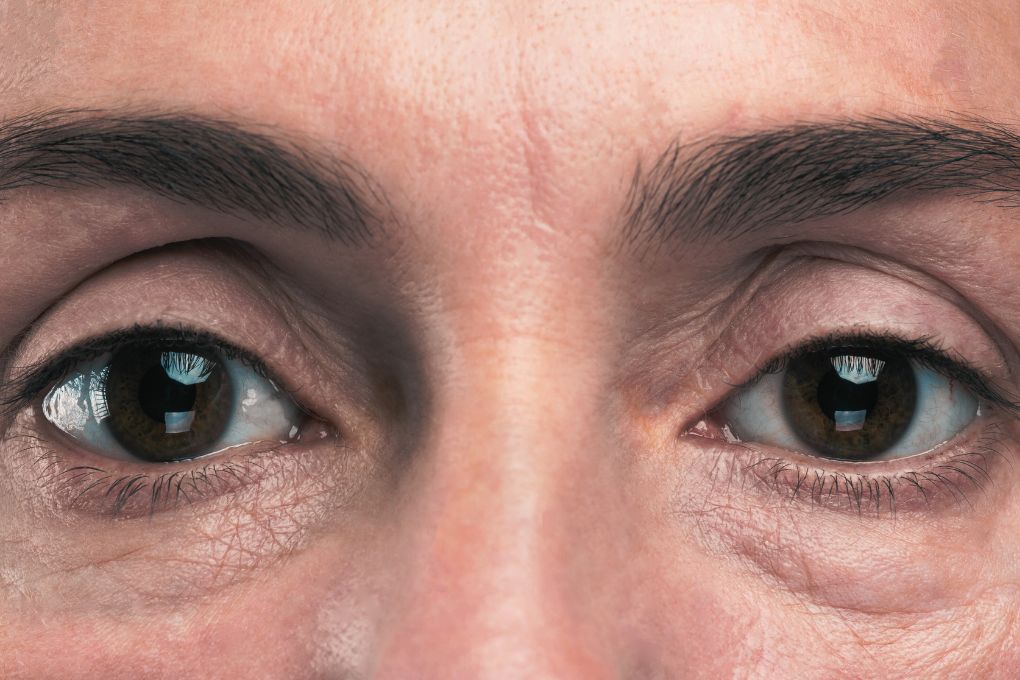 Nahaufnahme eines Gesichts mit sichtbaren Fältchen unter den Augen – typische Hautveränderungen in den Wechseljahren und im Alter